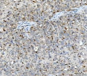 IHC staining of FFPE human squamous cell carcinoma tissue with STK15 antibody. HIER: boil tissue sections in pH8 EDTA for 20 min and allow to cool before testing.