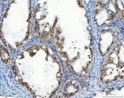 IHC staining of FFPE human ovarian cancer tissue with STK15 antibody. HIER: boil tissue sections in pH8 EDTA for 20 min and allow to cool before testing.