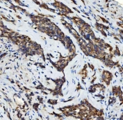 IHC staining of FFPE human lung adenocarcinoma tissue with STK15 antibody. HIER: boil tissue sections in pH8 EDTA for 20 min and allow to cool before testing.