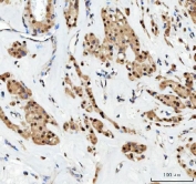 IHC staining of FFPE human renal oncocytoma tissue with STK15 antibody. HIER: boil tissue sections in pH8 EDTA for 20 min and allow to cool before testing.
