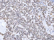 IHC staining of FFPE human breast cancer tissue with STK15 antibody. HIER: boil tissue sections in pH8 EDTA for 20 min and allow to cool before testing.