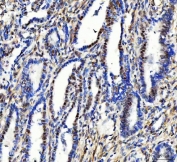 IHC staining of FFPE human cervical cancer tissue with STK15 antibody. HIER: boil tissue sections in pH8 EDTA for 20 min and allow to cool before testing.