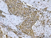 IHC staining of FFPE human esophageal squamous carcinoma tissue with Heat shock factor protein 1 antibody. HIER: boil tissue sections in pH8 EDTA for 20 min and allow to cool before testing.