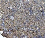 IHC staining of FFPE human squamous cell carcinoma of the cervix with Heat shock factor protein 1 antibody. HIER: boil tissue sections in pH8 EDTA for 20 min and allow to cool before testing.