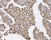 IHC staining of FFPE human lung cancer tissue with Heat shock factor protein 1 antibody. HIER: boil tissue sections in pH8 EDTA for 20 min and allow to cool before testing.