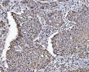 IHC staining of FFPE human esophageal squamous carcinoma tissue with Histone deacetylase 1 antibody. HIER: boil tissue sections in pH8 EDTA for 20 min and allow to cool before testing.