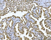 IHC staining of FFPE human lung cancer tissue with Histone deacetylase 1 antibody. HIER: boil tissue sections in pH8 EDTA for 20 min and allow to cool before testing.