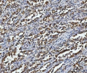 IHC staining of FFPE human hepatocellular carcinoma tissue with ACO2 antibody. HIER: boil tissue sections in pH8 EDTA for 20 min and allow to cool before testing.
