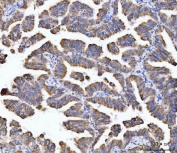 IHC staining of FFPE human lung adenocarcinoma tissue with ACO2 antibody. HIER: boil tissue sections in pH8 EDTA for 20 min and allow to cool before testing.
