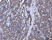 IHC staining of FFPE human testicular germ cell tumor tissue with ACO2 antibody. HIER: boil tissue sections in pH8 EDTA for 20 min and allow to cool before testing.