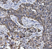 IHC staining of FFPE human laryngeal squamous cell carcinoma tissue with ACO2 antibody. HIER: boil tissue sections in pH8 EDTA for 20 min and allow to cool before testing.