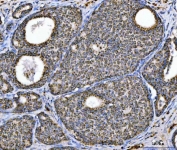 IHC staining of FFPE human breast cancer tissue with ACO2 antibody. HIER: boil tissue sections in pH8 EDTA for 20 min and allow to cool before testing.