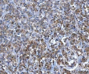 IHC staining of FFPE human gastric lymphoma tissue with CAD Protein antibody. HIER: boil tissue sections in pH8 EDTA for 20 min and allow to cool before testing.