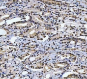 IHC staining of FFPE human prostate cancer tissue with CAD Protein antibody. HIER: boil tissue sections in pH8 EDTA for 20 min and allow to cool before testing.