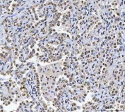 IHC staining of FFPE human lung adenocarcinoma tissue with CAD Protein antibody. HIER: boil tissue sections in pH8 EDTA for 20 min and allow to cool before testing.