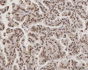 IHC staining of FFPE human lung adenocarcinoma tissue with PC4 antibody. HIER: boil tissue sections in pH8 EDTA for 20 min and allow to cool before testing.