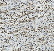 IHC staining of FFPE human hepatocellular carcinoma tissue with PC4 antibody. HIER: boil tissue sections in pH8 EDTA for 20 min and allow to cool before testing.