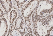 IHC staining of FFPE human colorectal adenocarcinoma tissue with PC4 antibody. HIER: boil tissue sections in pH8 EDTA for 20 min and allow to cool before testing.