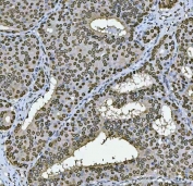 IHC staining of FFPE human breast cancer tissue with PC4 antibody. HIER: boil tissue sections in pH8 EDTA for 20 min and allow to cool before testing.