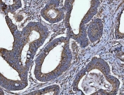 IHC staining of FFPE human colorectal adenocarcinoma tissue with HMG CoA Reductase antibody. HIER: boil tissue sections in pH8 EDTA for 20 min and allow to cool before testing.