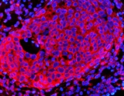 Immunofluorescent staining of FFPE human breast cancer tissue with HMG CoA Reductase antibody (red) and DAPI nuclear stain (blue). HIER: steam section in pH8 EDTA buffer for 20 min.