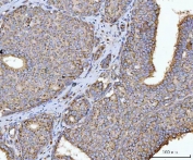 IHC staining of FFPE human breast cancer tissue with HMG CoA Reductase antibody. HIER: boil tissue sections in pH8 EDTA for 20 min and allow to cool before testing.