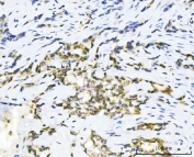 IHC staining of FFPE human lung adenocarcinoma tissue with Glycogen synthase kinase-3 beta antibody. HIER: boil tissue sections in pH8 EDTA for 20 min and allow to cool before testing.