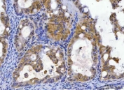 IHC staining of FFPE human ovarian cancer tissue with Glycogen synthase kinase-3 beta antibody. HIER: boil tissue sections in pH8 EDTA for 20 min and allow to cool before testing.