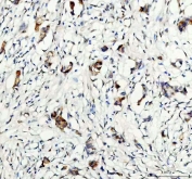 IHC staining of FFPE human breast cancer tissue with Glycogen synthase kinase-3 beta antibody. HIER: boil tissue sections in pH8 EDTA for 20 min and allow to cool before testing.