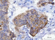 IHC staining of FFPE human laryngeal squamous cell carcinoma tissue with JUP antibody. HIER: boil tissue sections in pH8 EDTA for 20 min and allow to cool before testing.