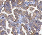 IHC staining of FFPE human lung adenocarcinoma tissue with JUP antibody. HIER: boil tissue sections in pH8 EDTA for 20 min and allow to cool before testing.