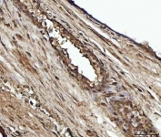 IHC staining of FFPE human prostate cancer tissue with YWHAE antibody. HIER: boil tissue sections in pH8 EDTA for 20 min and allow to cool before testing.