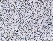 IHC staining of FFPE human glioblastoma tissue with TCF-8 antibody. HIER: boil tissue sections in pH8 EDTA for 20 min and allow to cool before testing.