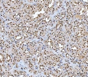 IHC staining of FFPE human thyroid cancer tissue with TCF-8 antibody. HIER: boil tissue sections in pH8 EDTA for 20 min and allow to cool before testing.