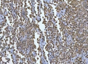 IHC staining of FFPE human testicular germ cell tumor tissue with TCF-8 antibody. HIER: boil tissue sections in pH8 EDTA for 20 min and allow to cool before testing.