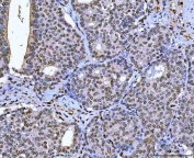 IHC staining of FFPE human breast cancer tissue with TCF-8 antibody. HIER: boil tissue sections in pH8 EDTA for 20 min and allow to cool before testing.