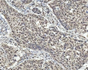 IHC staining of FFPE human laryngeal squamous cell carcinoma tissue with TCF-8 antibody. HIER: boil tissue sections in pH8 EDTA for 20 min and allow to cool before testing.