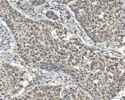 IHC staining of FFPE human laryngeal squamous cell carcinoma tissue with TCF-8 antibody. HIER: boil tissue sections in pH8 EDTA for 20 min and allow to cool before testing.