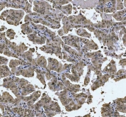 IHC staining of FFPE human lung adenocarcinoma tissue with TCF-8 antibody. HIER: boil tissue sections in pH8 EDTA for 20 min and allow to cool before testing.