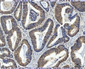 IHC staining of FFPE human colorectal adenocarcinoma tissue with TCF-8 antibody. HIER: boil tissue sections in pH8 EDTA for 20 min and allow to cool before testing.