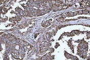 IHC staining of FFPE human lung adenocarcinoma tissue with HBEGF antibody. HIER: boil tissue sections in pH8 EDTA for 20 min and allow to cool before testing.