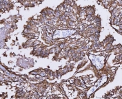 IHC staining of FFPE human adenocarcinoma of the lung with C-1-tetrahydrofolate synthase antibody. HIER: boil tissue sections in pH8 EDTA for 20 min and allow to cool before testing.