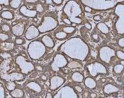 IHC staining of FFPE human thyroid cancer tissue with C-1-tetrahydrofolate synthase antibody. HIER: boil tissue sections in pH8 EDTA for 20 min and allow to cool before testing.