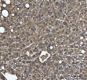 IHC staining of FFPE human liver cancer tissue with C-1-tetrahydrofolate synthase antibody. HIER: boil tissue sections in pH8 EDTA for 20 min and allow to cool before testing.