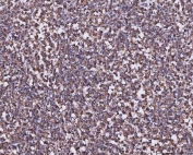 IHC staining of FFPE human diffuse large B cell lymphoma tissue with C-1-tetrahydrofolate synthase antibody. HIER: boil tissue sections in pH8 EDTA for 20 min and allow to cool before testing.