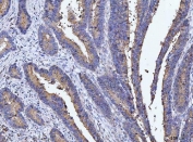 IHC staining of FFPE human rectal cancer tissue with DEP1 antibody. HIER: boil tissue sections in pH8 EDTA for 20 min and allow to cool before testing.
