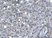 IHC staining of FFPE human liver cancer tissue with DEP1 antibody. HIER: boil tissue sections in pH8 EDTA for 20 min and allow to cool before testing.