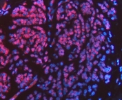 Immunofluorescent staining of FFPE human breast cancer tissue with FIP1L1 antibody (red) and DAPI nuclear stain (blue). HIER: steam section in pH8 EDTA buffer for 20 min.