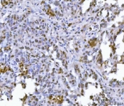 IHC staining of FFPE high-grade serous carcinoma of human ovary tissue with FIP1L1 antibody. HIER: boil tissue sections in pH8 EDTA for 20 min and allow to cool before testing.