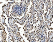 IHC staining of FFPE human lung adenocarcinoma tissue with FIP1L1 antibody. HIER: boil tissue sections in pH8 EDTA for 20 min and allow to cool before testing.